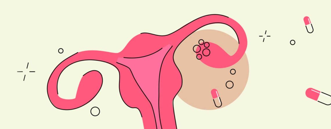 قرص متفورمین یا گلوکوفاژ برای کیست و تنبلی تخمدان