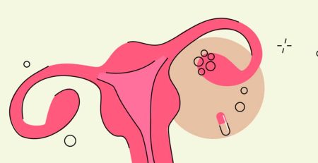 قرص متفورمین یا گلوکوفاژ برای کیست و تنبلی تخمدان